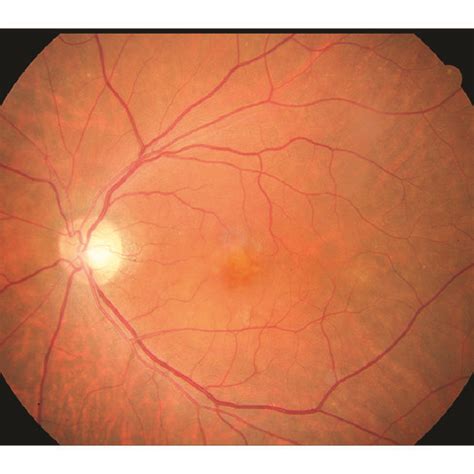 wet amd|wet amd pubmed.